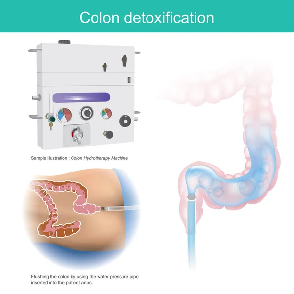 Désintoxication du côlon. Exemple d'illustration rinçant le côlon par — Image vectorielle