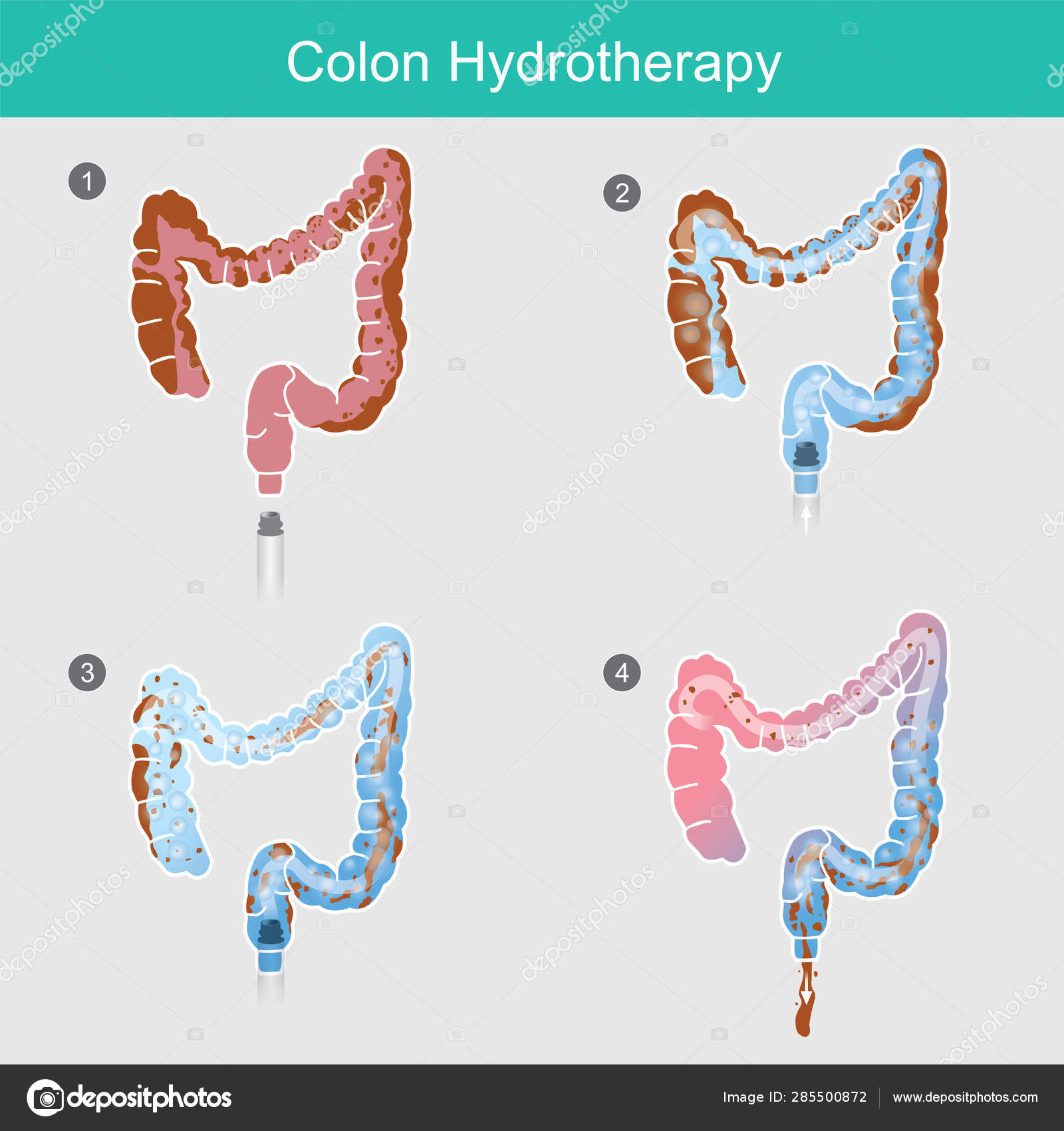 hidroterapie colon