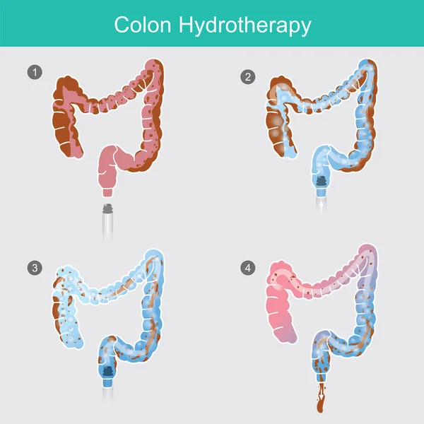 Colon Hydrotherapy — Stock Vector