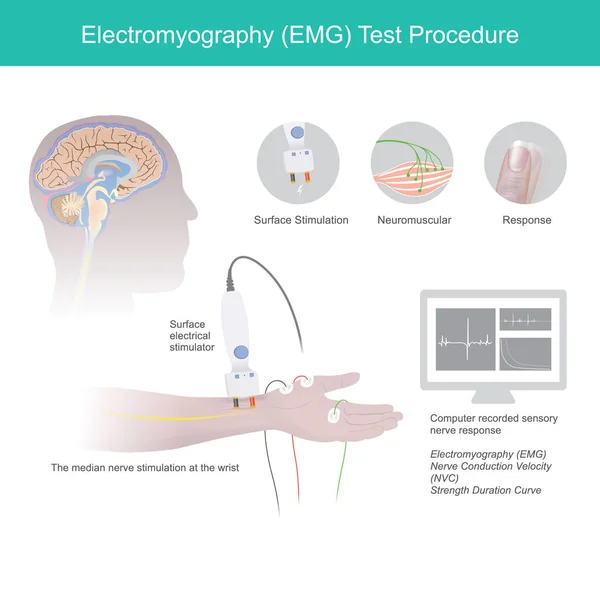 Procedimento de teste de eletromiografia . — Vetor de Stock