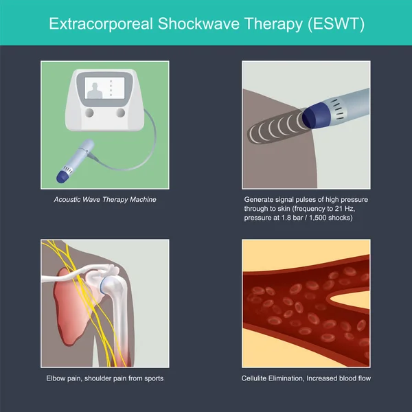 Ekstrakorporeal Shockwave Tedavisi. — Stok Vektör