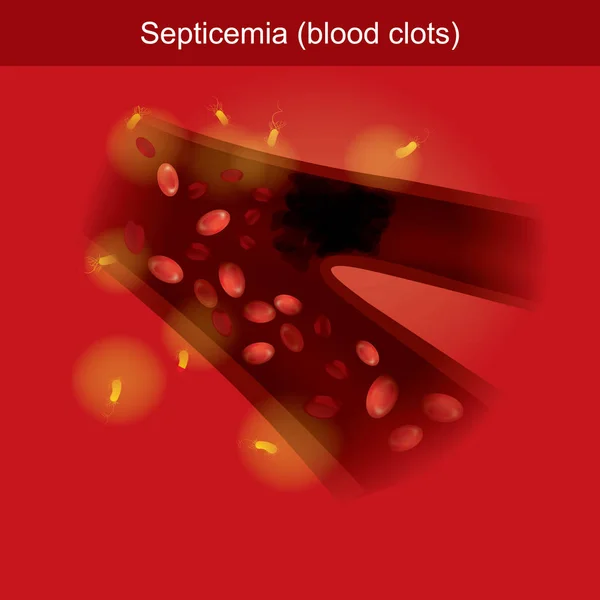 Septicemia infographic 3d Illustration. — Stock Vector
