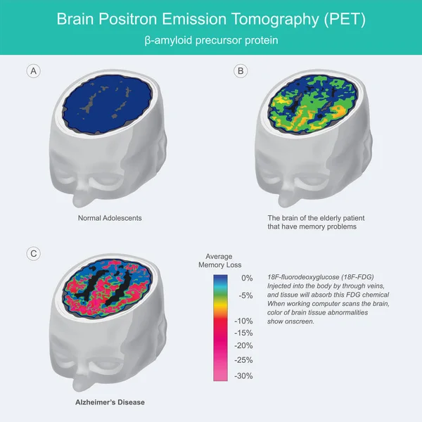 Beyin Pet taramaları. Çalışan bilgisayar beyni tararken, renk o — Stok Vektör