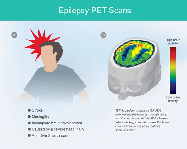 Epilepsie-Haustierscans. Gehirnzellen bei Gehirnerschütterung oder Epilepsie — Stockvektor