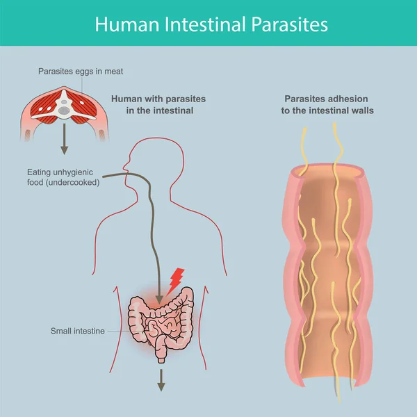 人类肠道寄生虫Human Intestinal Parasites 图例解释人类小肠内的寄生虫 是由于食用受感染肉类或未煮熟肉类中的寄生虫蛋而引致的 — 图库矢量图片