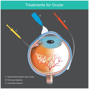 Göz Hastalığı Tedavisi. İllülasyon, gözdeki anormal kan damarının neden olduğu retinal hastalıkların tedavisini açıklıyor.