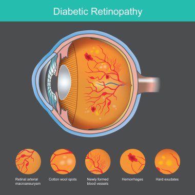 Diyabetik Retinopati. İmaj anormalliği. Retina semptomları. Retinopati.
