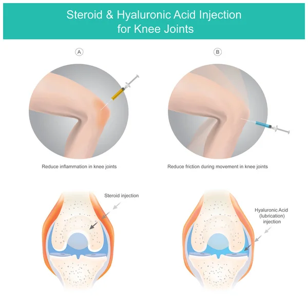 Injection Stéroïdes Acide Hyaluronique Pour Les Articulations Genou Illustration Expliquer — Image vectorielle