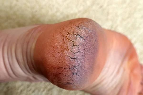 İhmal edilmiş bir insan topuğu, çatlak bir topuk, kirli ve çatlak bir insan topuğu.,