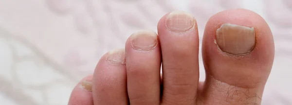 Cuidados Com Pés Unhas Corte Unhas Compridas Limpeza Pessoal — Fotografia de Stock