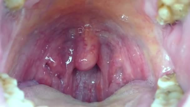 無視された人間の口と炎症を起こした扁桃腺 — ストック動画