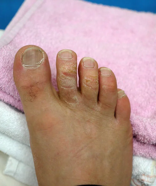 Παραμελημένα Αρσενικά Πόδια Επιμήκη Νύχια Και Παραμελημένα Δάχτυλα Ποδιών — Φωτογραφία Αρχείου