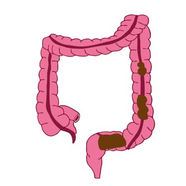 Kabızlıktan kabız olmuş kalın bağırsak, kabızlık hastalığı tıbbi illüstrasyon.