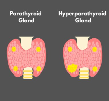 parathyroid gland versus hyperparathyroid gland comparison diofference diagram medical illustrations useful for healthcare and educational purposes - 1