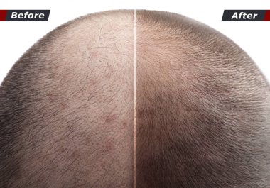 Erkekler saç kozmetik toz, krem, sprey saç kalınlaşmasına kullandıktan sonra. Önce ve sonra