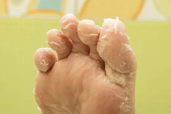 Peeling skin on the toes of a woman. Asian masks for the skin of the feet, peeling. Skin renewal effect