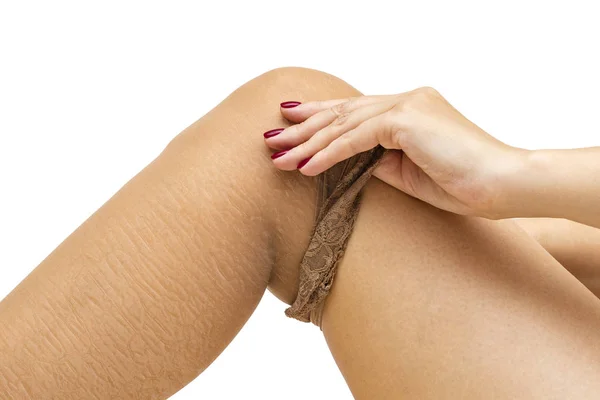 Girl Takes Her Pantyhose Dry Skin Cracks Skin Legs Concept — Stock Photo, Image