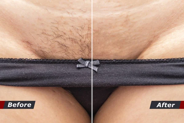 Depilasyon kavramı. Önce ve sonra etkisi. Kozmetik toz, krem, epilasyon için sprey kullandıktan sonra etkisi