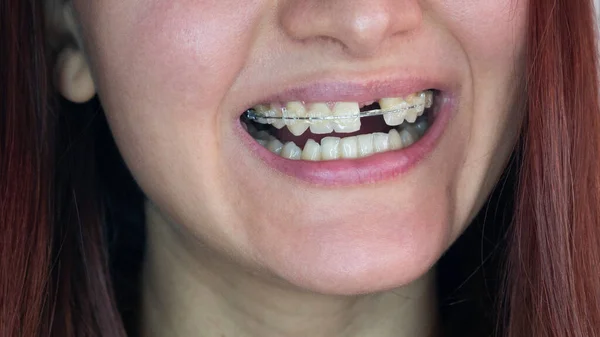 Улыбка Молодой Женщины Единого Переднего Зуба Улыбайтесь Зубов Верхнего Левого — стоковое фото
