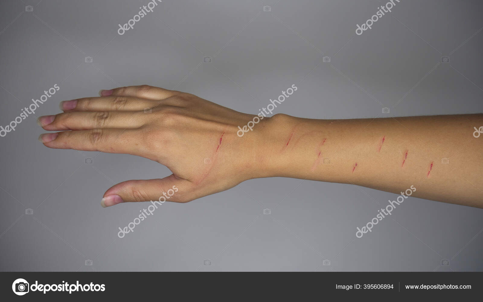 Katzenkratzerkrankheit Eine Zerkratzte Weibliche Hand Von Einer Katze –  Stockfoto © nivcube #395606894, image size:1600x1000