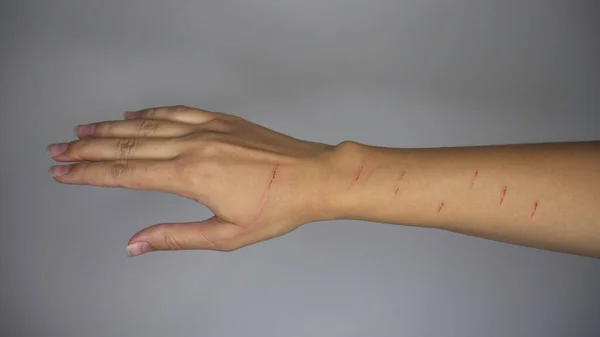 Cat Scratch Disease. A scratched female hand from a cat.