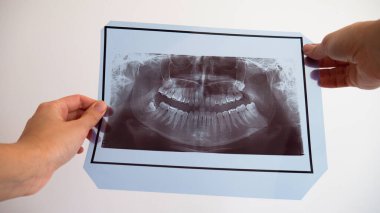 X-ray diş taraması yapan kadınların elleri. Diş teli ile üst dişler.