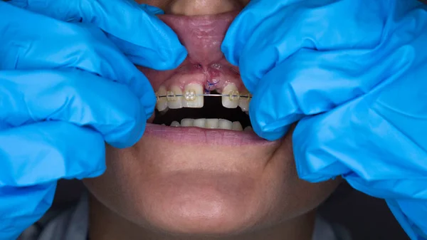 Ferida Boca Após Colocação Implante Cirurgia Implantes Dentários — Fotografia de Stock