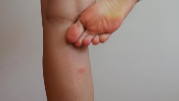 Pied Femme Gratte Piqûre Insecte Sur Jambe — Video