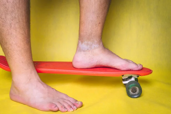 Man\'s feet with skin pigmentation problems on the ankle, with a red scooter on a yellow background.