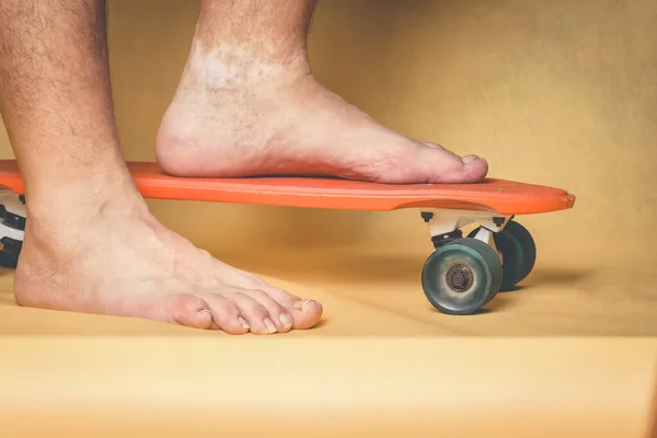 Man\'s feet with skin pigmentation problems on the ankle, with a red scooter on a yellow background.