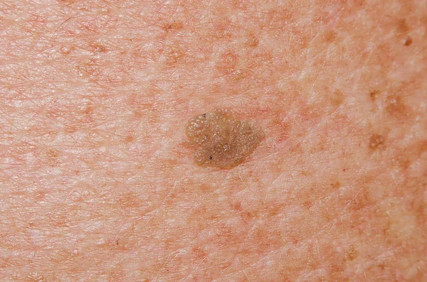 Doğum izine benzer bir yaşlı adam yakın çekim vücudunda Papillom