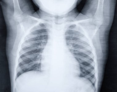 Zatürre olan 5 yaşındaki çocuk akciğerlerde X-Ray