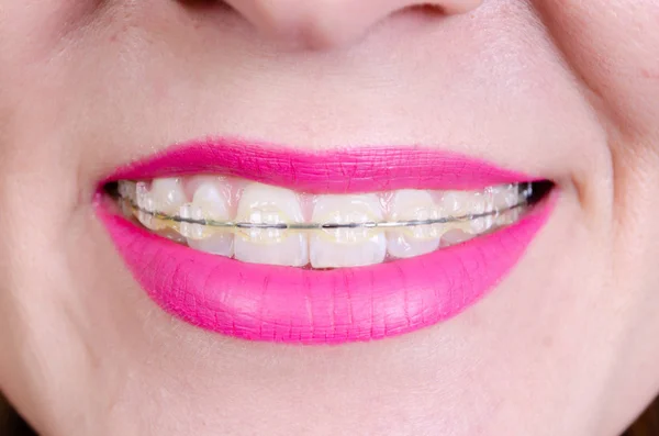 Teeth with sapphire braces and a smile of a young woman with painted lips.