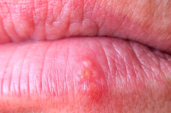 Virus Herpès Sur Lèvre Inférieure Mâle Adulte Gros Plan — Photo