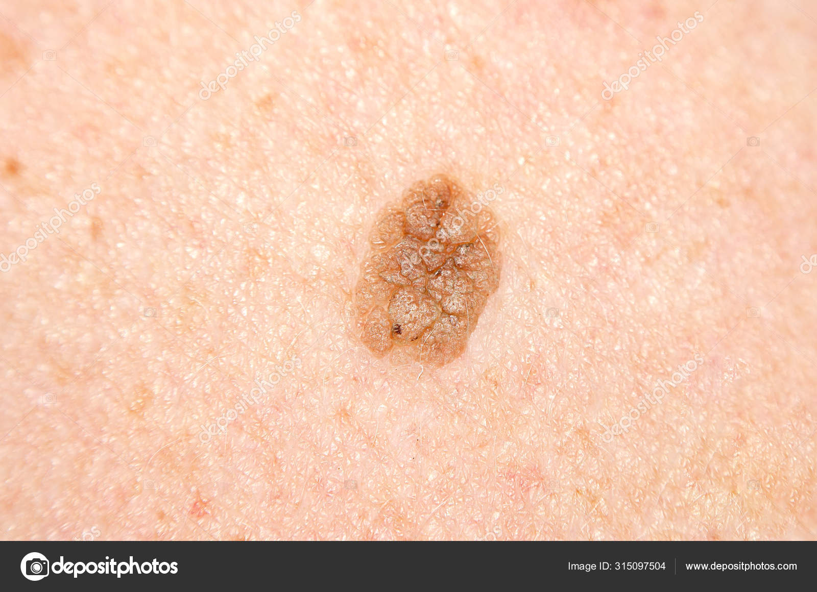 papilloma in skin)