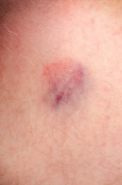 Bruise Skin Human Body Closeup — Stock Photo, Image