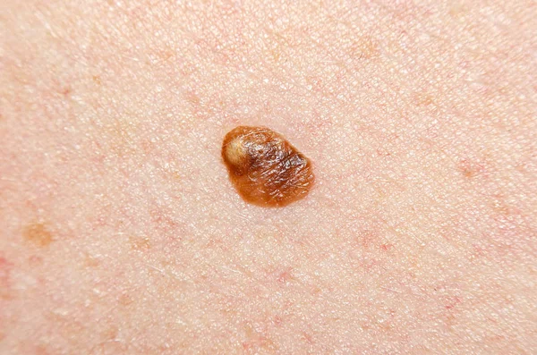 Nevus Vagy Anyajegy Emberi Bőrön Közelkép — Stock Fotó