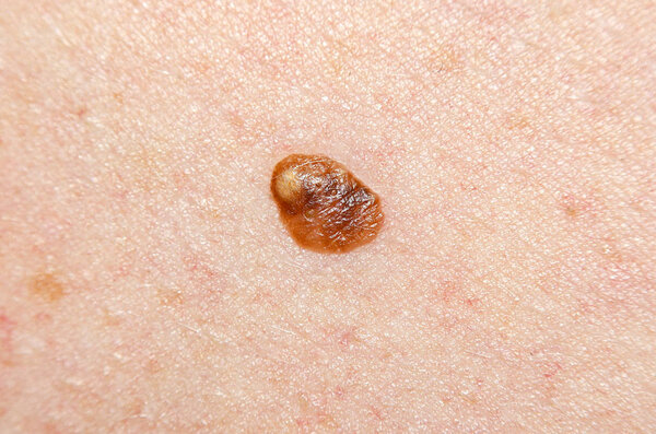 Nevus, or mole in the human skin close-up