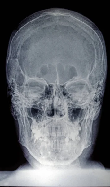 Egy Felnőtt Férfi Koponyájának Röntgenképe Stock Kép