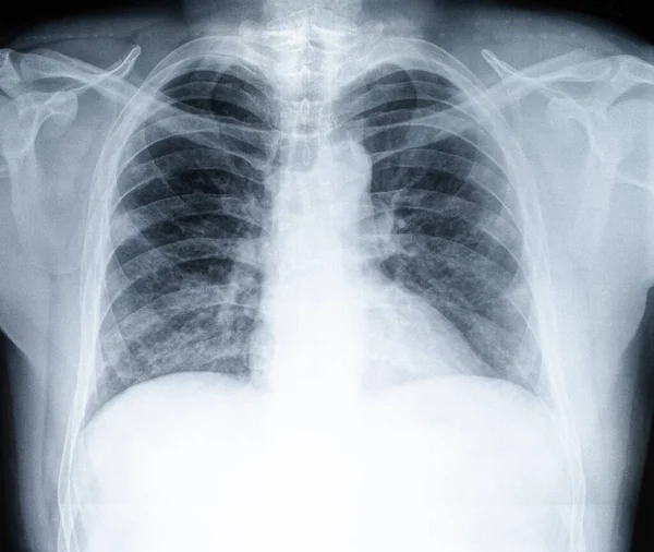 Radiographie Thoracique Patient Covide Photos De Stock Libres De Droits