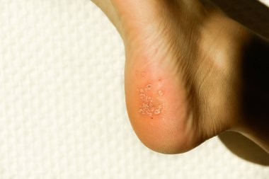 A close-up of a foots heel shows a large, significant cluster of warts. This image is suitable for illustrating advanced podiatric conditions and skin pathology.