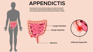 Appendicitis is the inflammation of the appendix requiring immediate medical attention and often surgery to prevent rupture