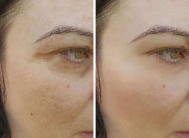 yüz kadın kırışıklıklar önce ve sonra