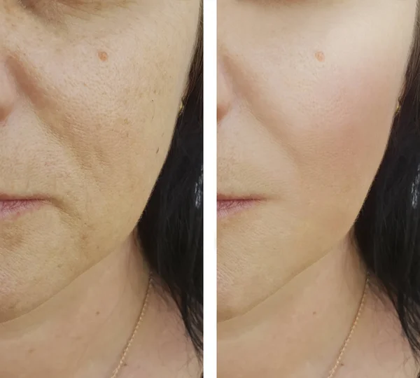 Wanita Wajah Keriput Sebelum Dan Sesudah Botox Pengisi — Stok Foto