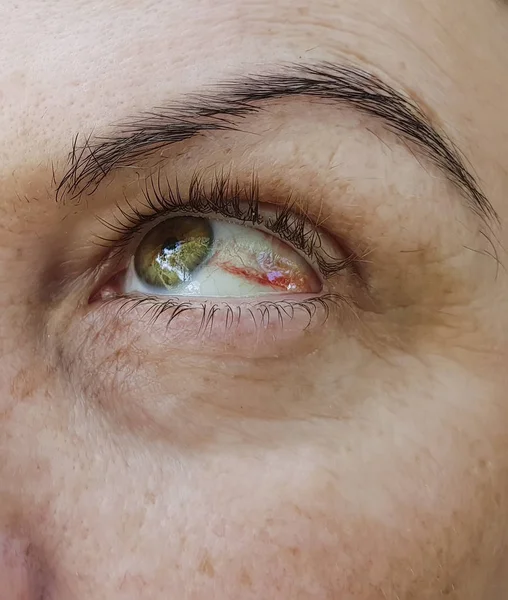 Mulher Olhos Vermelhos Conjuntivite — Fotografia de Stock