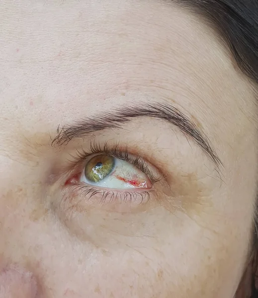 Mujer Ojos Rojos Conjuntivitis — Foto de Stock