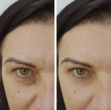 yüz kırışıklıklar önce ve sonra