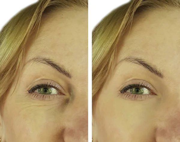Wanita Wajah Wface Keriput Sebelum Dan Afterrinkles Sebelum Dan Setelah — Stok Foto