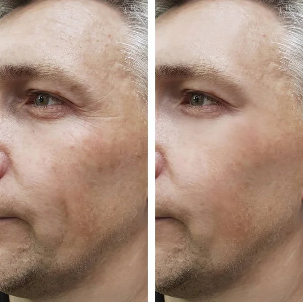 Лицо Человека Морщины После — стоковое фото