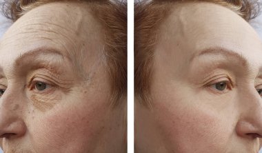 Yaşlı bir kadın yüzü kırışıklıklar daha önce ve sonra